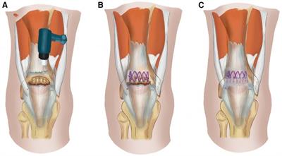 A <mark class="highlighted">retrospective case series</mark> of the treatment of spontaneous quadriceps tendon rupture in patients with uremia and secondary hyperparathyroidism